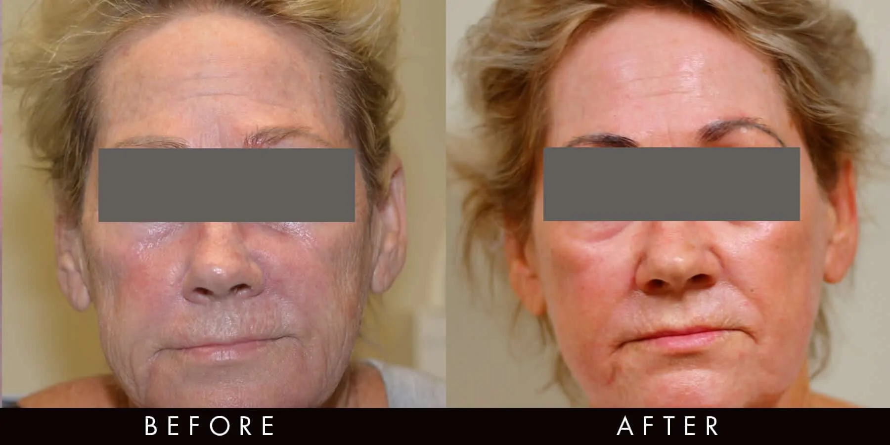 Laser Treatment Results Newcastle