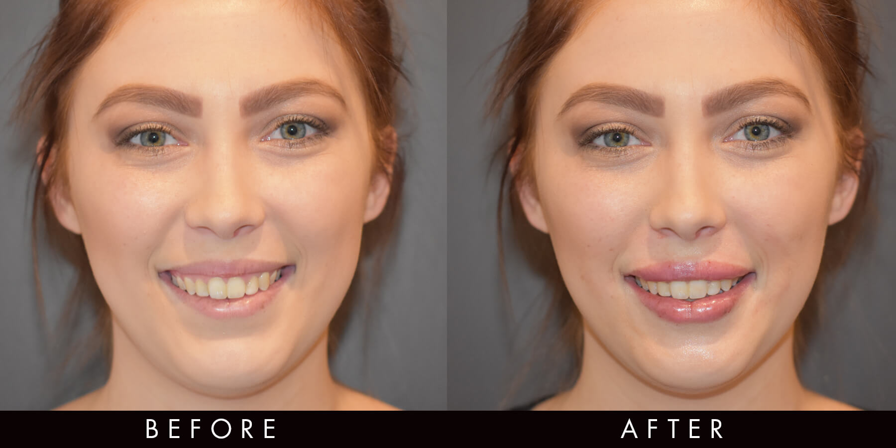 Lip Filler Before After Newcastle
