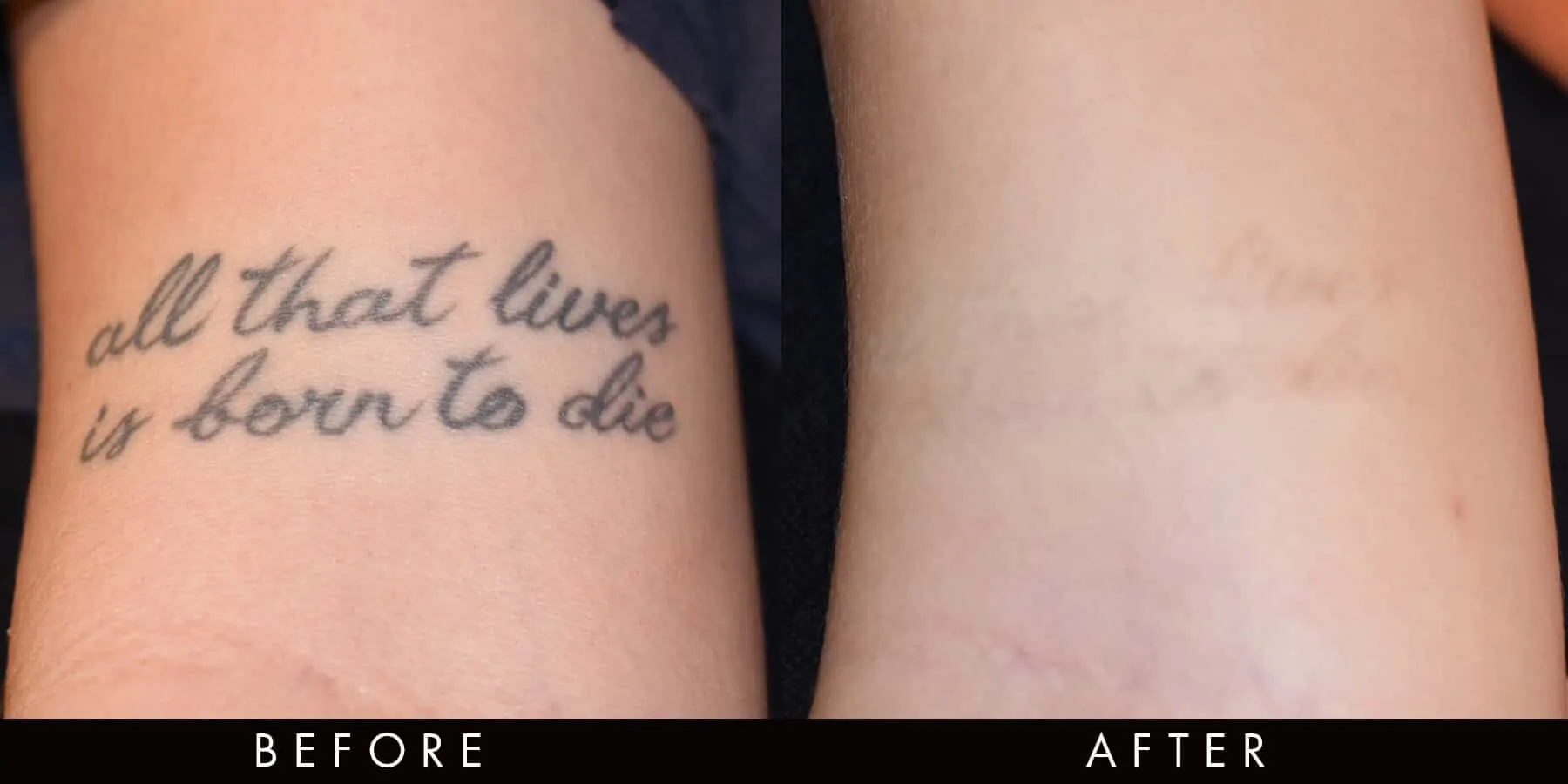Picoway Tattoo Removal Before After Newcastle