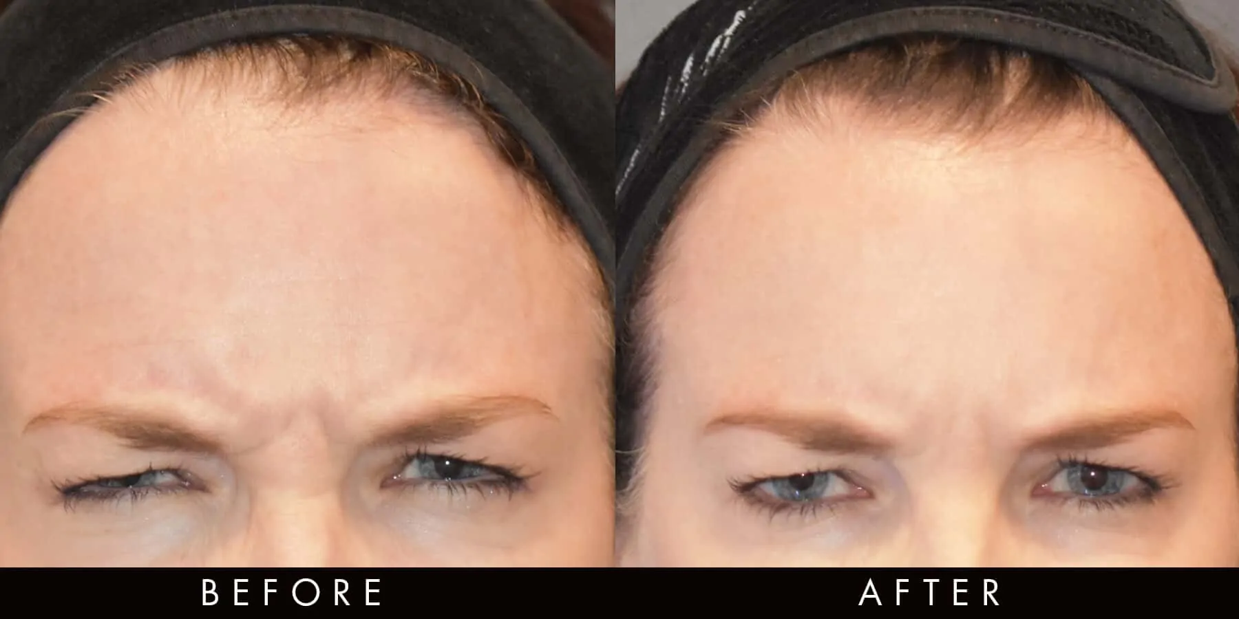 Anti-Wrinkle Injections Forehead Line Reduction newcastle