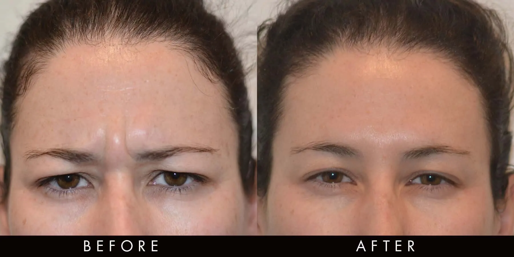 Anti-Wrinkle Injection Frown Lines Newcastle
