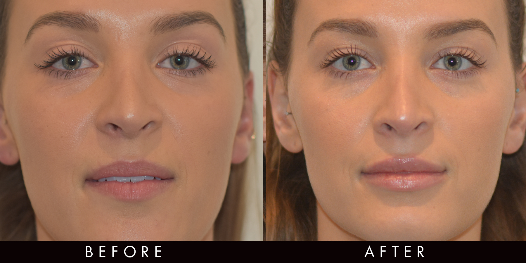Lip Filler Before & After Newcastle