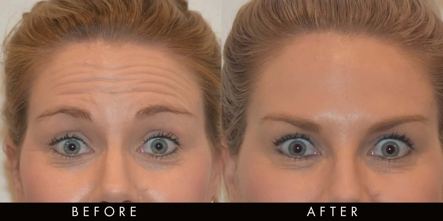 Anti-wrinkle for the reduction of forehead lines (client treated by Dr Monique)
