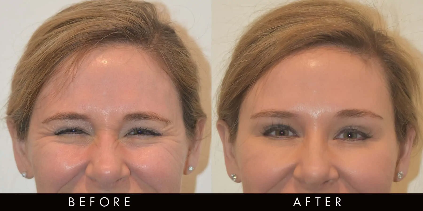 Anti-Wrinkle Injections Crows Feet Newcastle