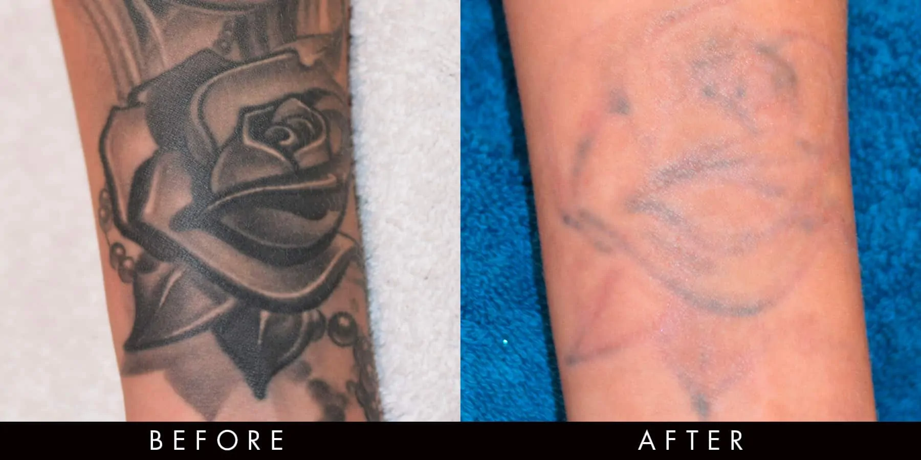 PicoWay Tattoo Removal Before & After Newcastle