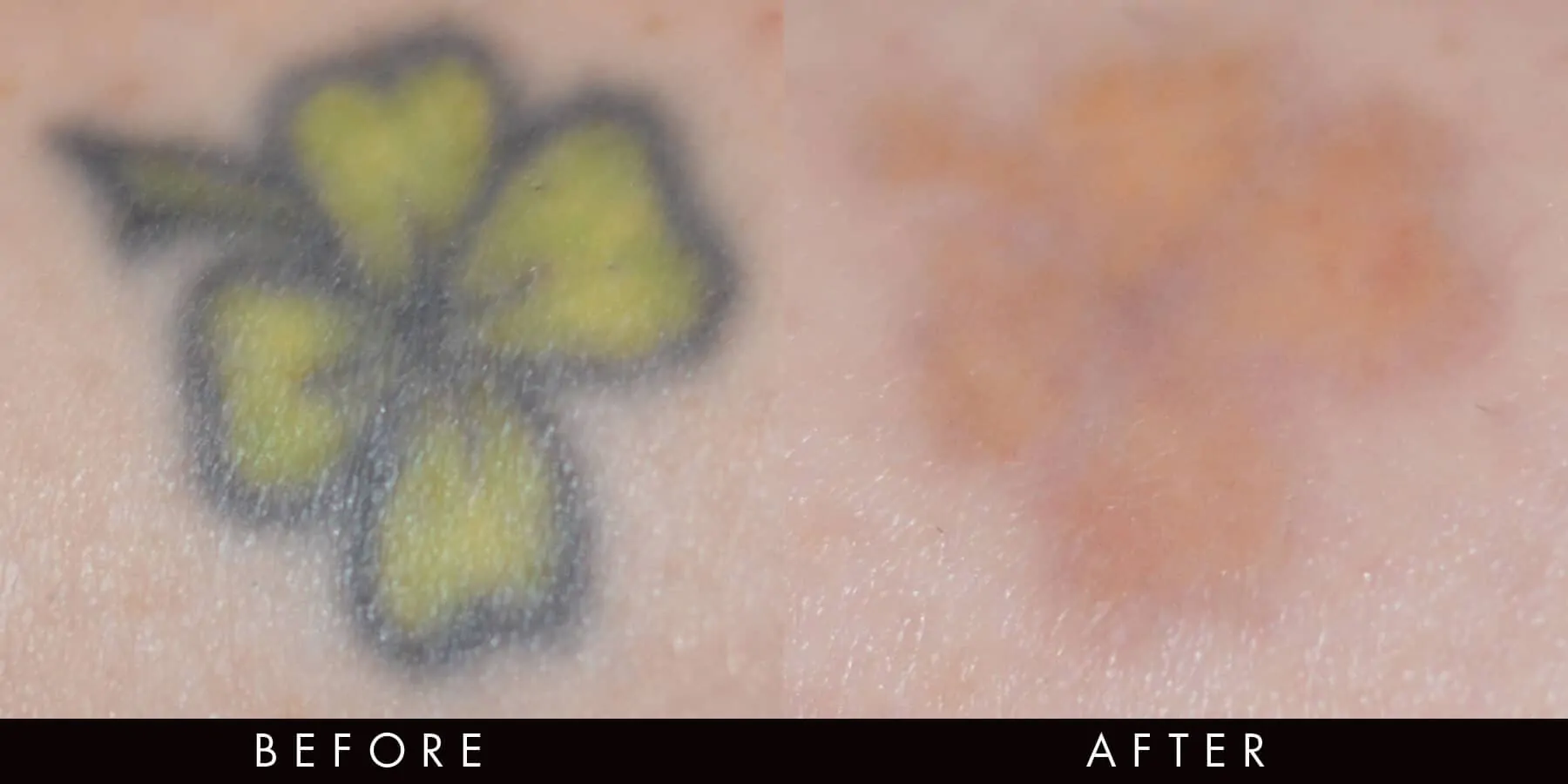 Laser Tattoo Removal Newcastle