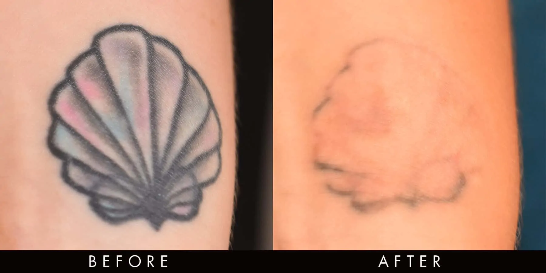 PicoWay Tattoo Laser Removal Newcastle