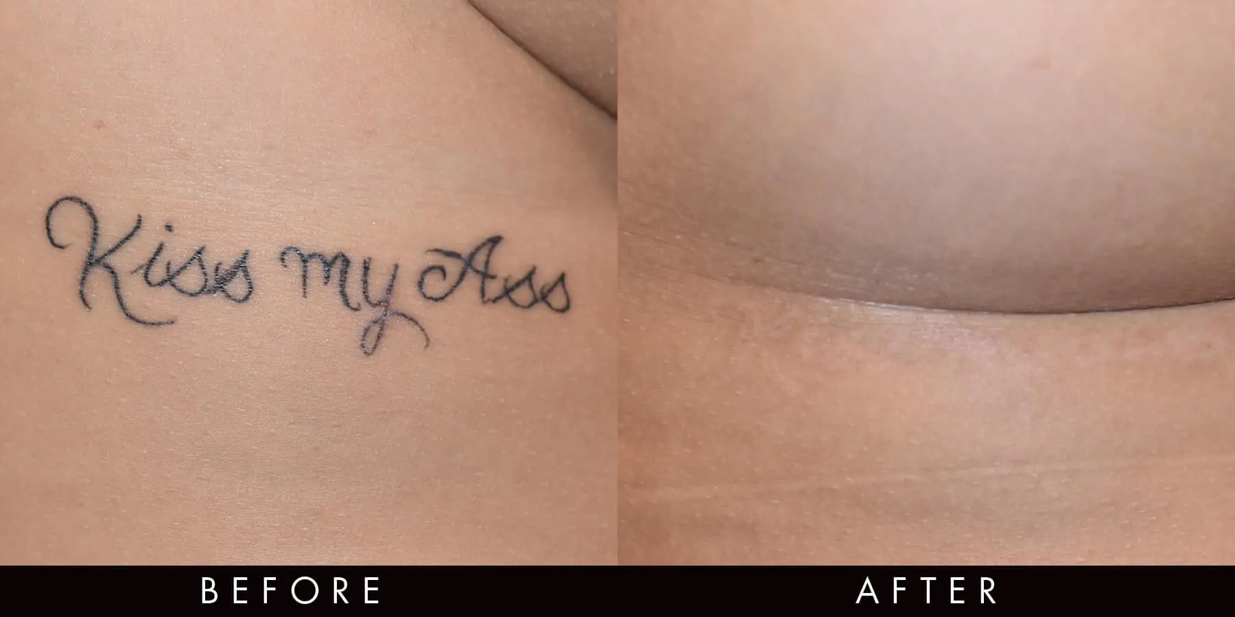 PicoWay Tattoo Removal Newcastle