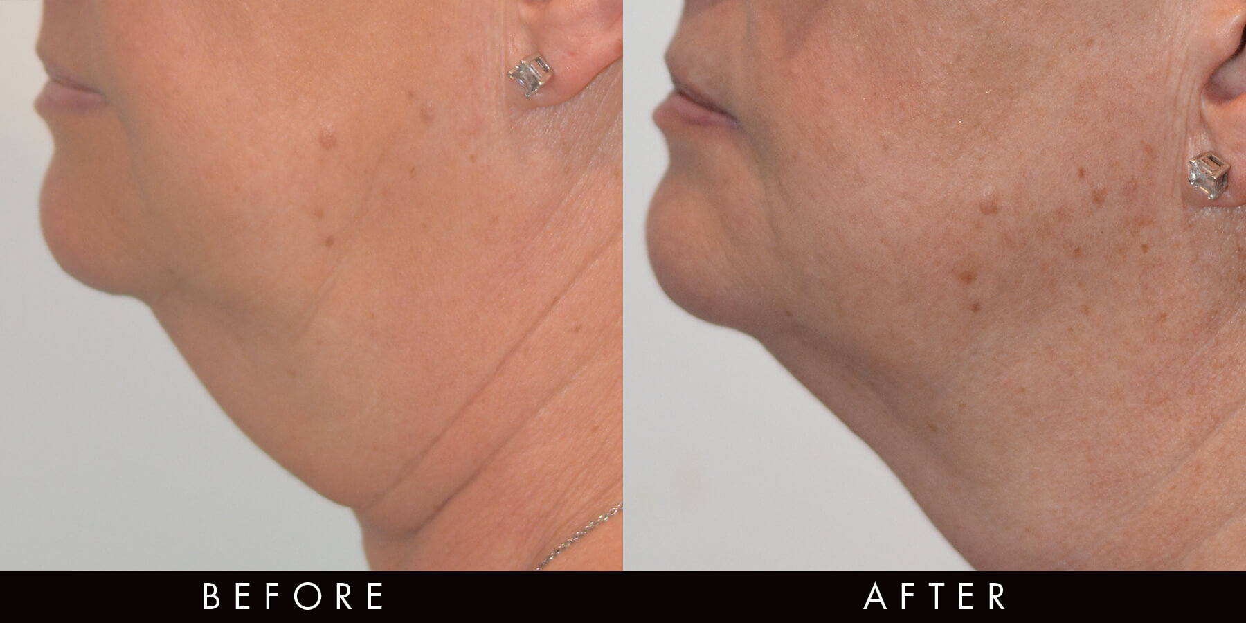 Chin jawline Dissolving Injections Before & After Newcastle