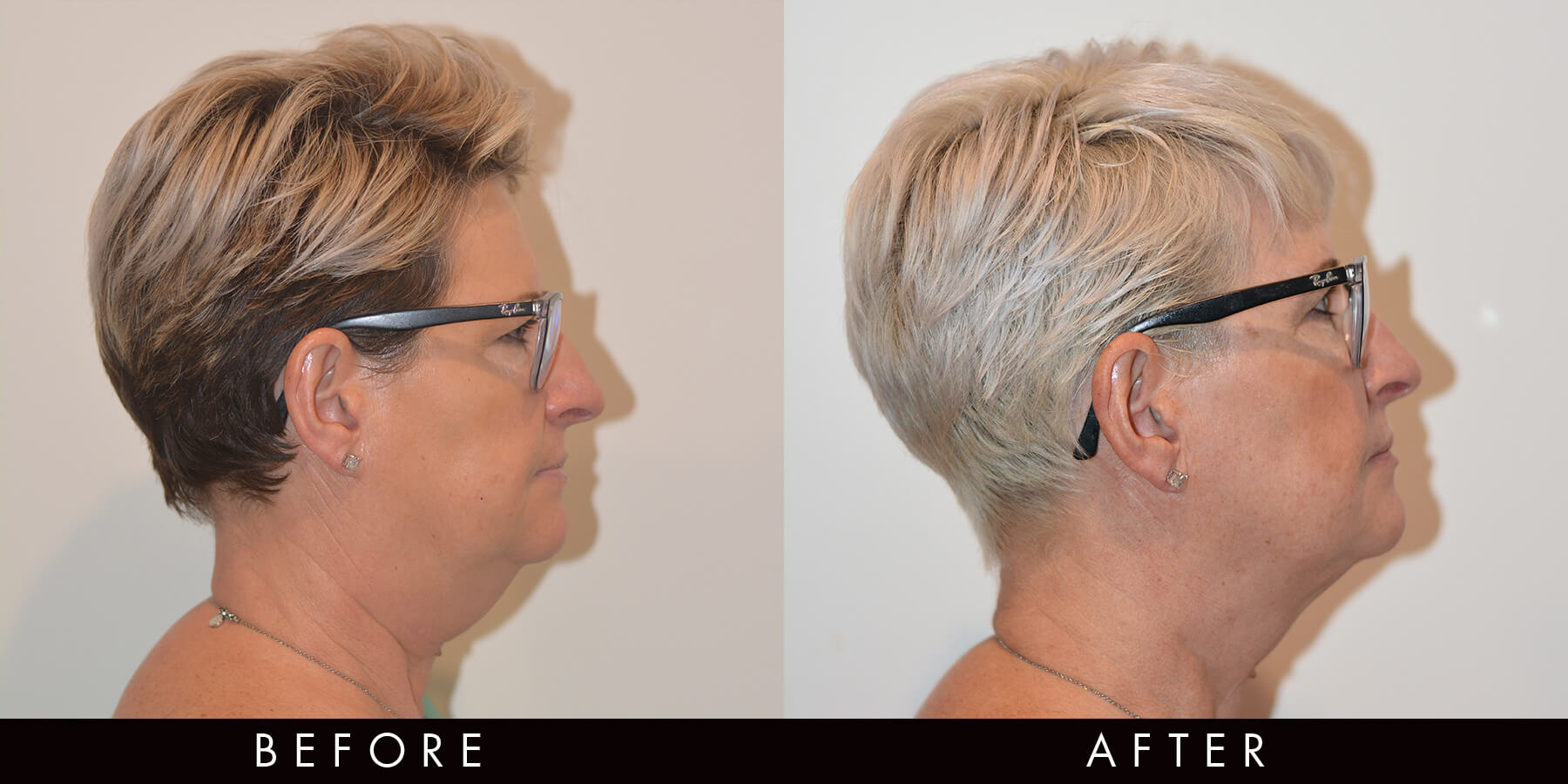 Chin Jawline Shaping Before & After Newcastle