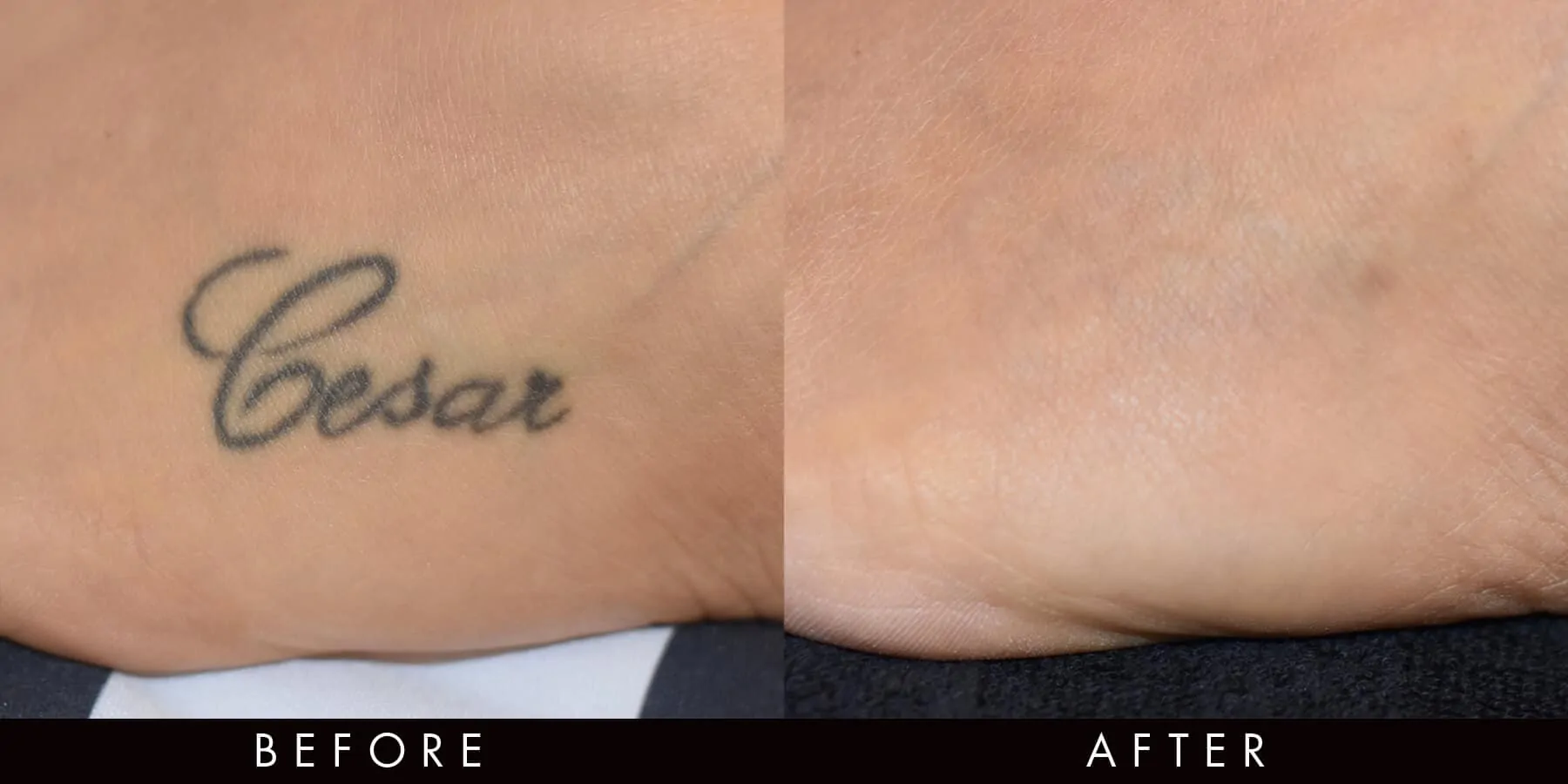 Tattoo Removal Before & After PicoWay Newcastle