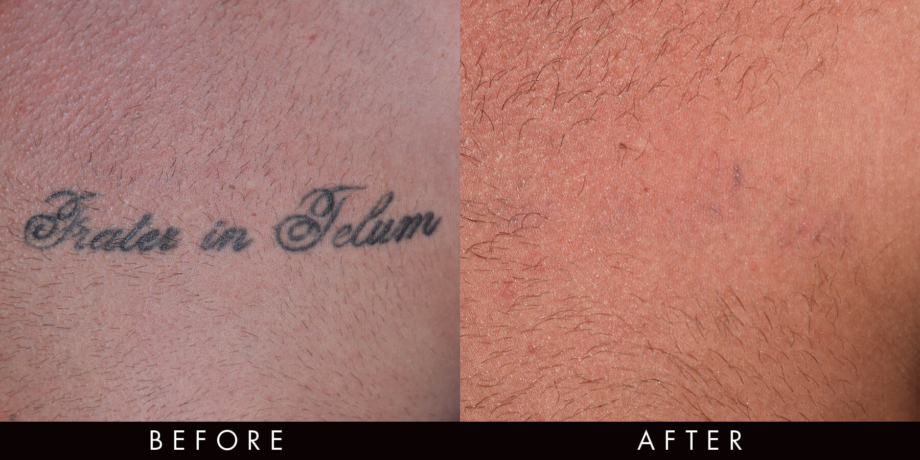 PicoWay Tattoo Removal Newcastle
