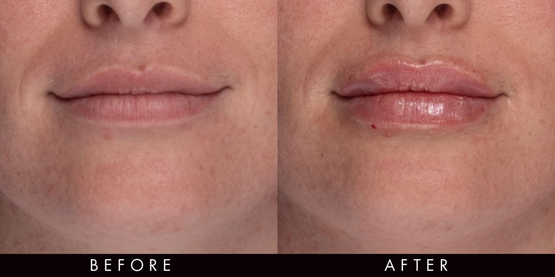 Dermal Lip Filler Newcastle